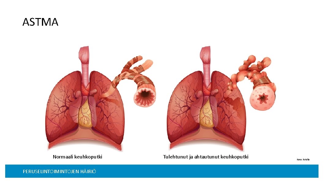 ASTMA Normaali keuhkoputki PERUSELINTOIMINTOJEN HÄIRIÖ Tulehtunut ja ahtautunut keuhkoputki Kuva: Fotolia Lisämääre, esim piirin/osaston