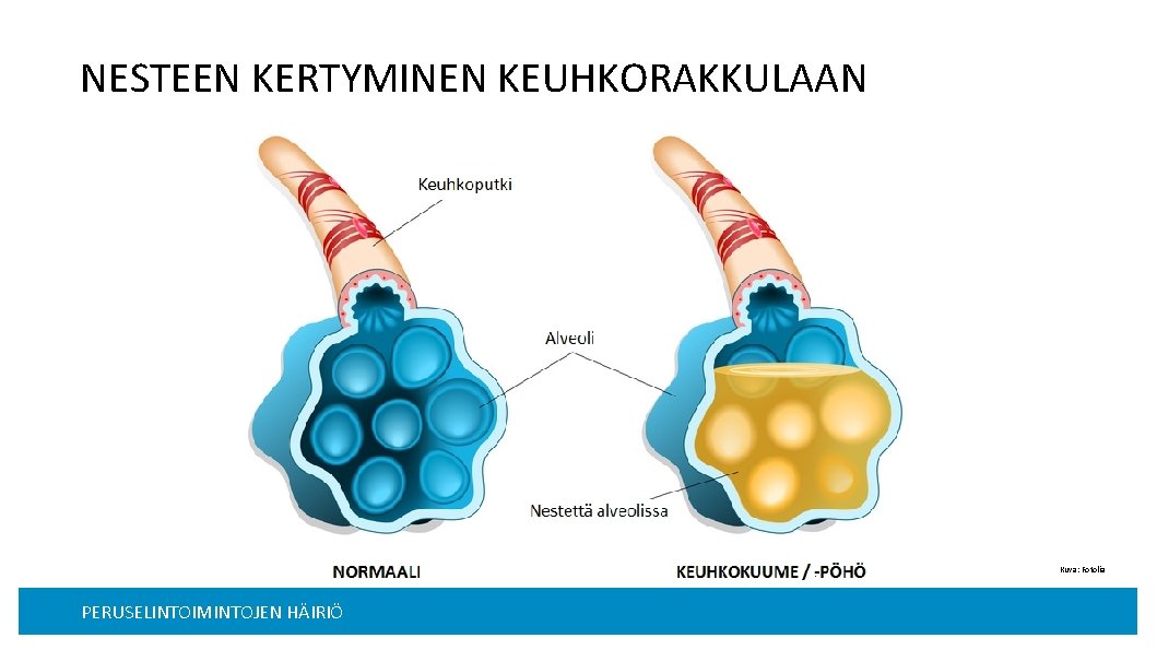 NESTEEN KERTYMINEN KEUHKORAKKULAAN Kuva: Fotolia PERUSELINTOIMINTOJEN HÄIRIÖ Lisämääre, esim piirin/osaston nimi, 21 