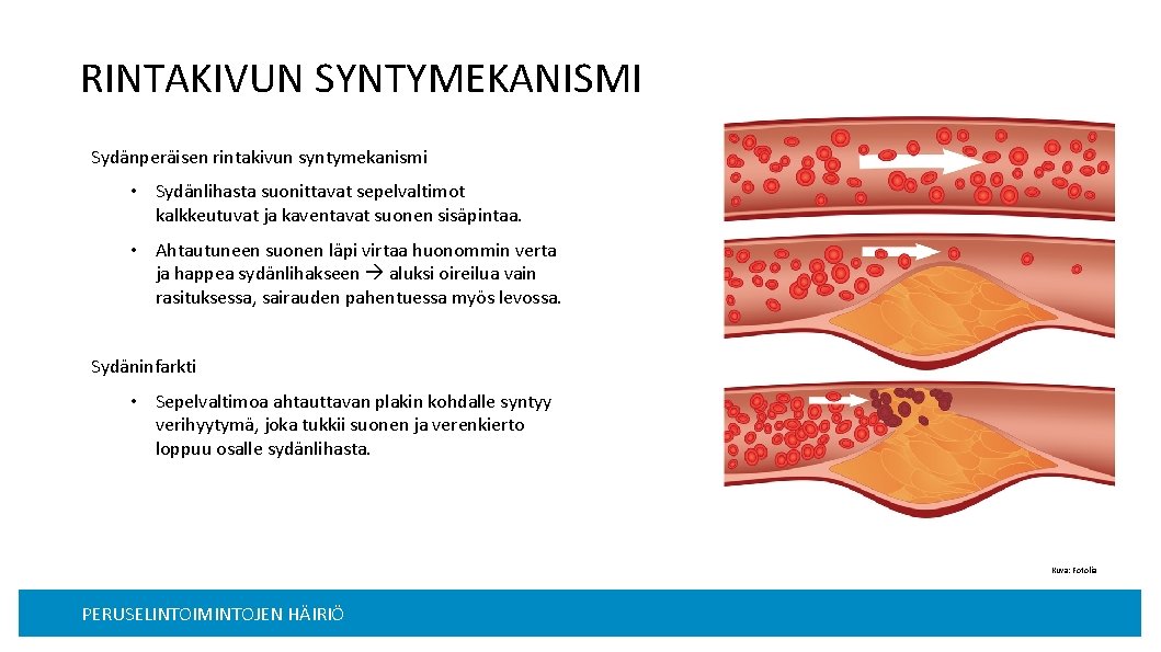 RINTAKIVUN SYNTYMEKANISMI Sydänperäisen rintakivun syntymekanismi • Sydänlihasta suonittavat sepelvaltimot kalkkeutuvat ja kaventavat suonen sisäpintaa.