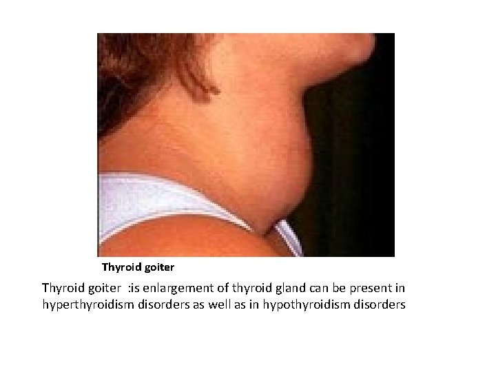 Thyroid goiter : is enlargement of thyroid gland can be present in hyperthyroidism disorders