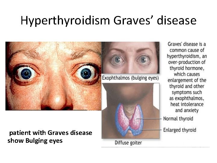 Hyperthyroidism Graves’ disease patient with Graves disease show Bulging eyes 