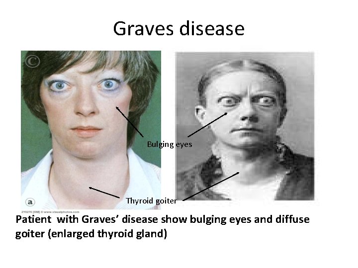 Graves disease Bulging eyes Thyroid goiter Patient with Graves’ disease show bulging eyes and