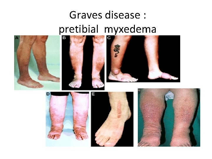 Graves disease : pretibial myxedema 