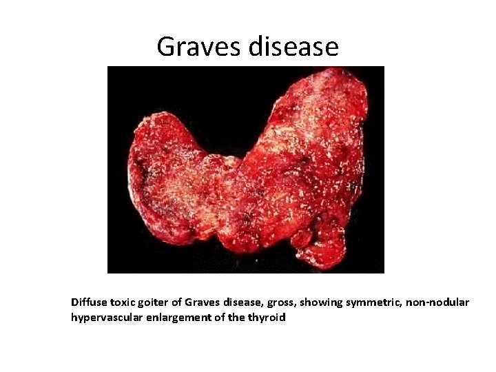 Graves disease Diffuse toxic goiter of Graves disease, gross, showing symmetric, non-nodular hypervascular enlargement
