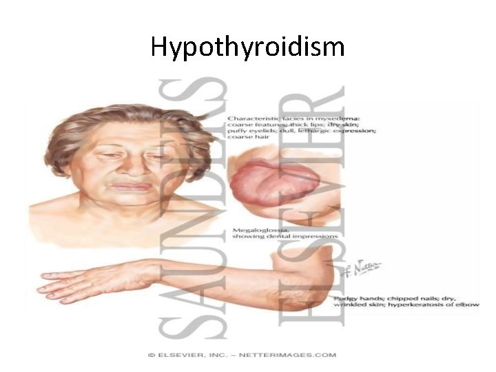 Hypothyroidism 