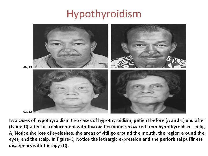 Hypothyroidism two cases of hypothyroidism, patient before (A and C) and after (B and