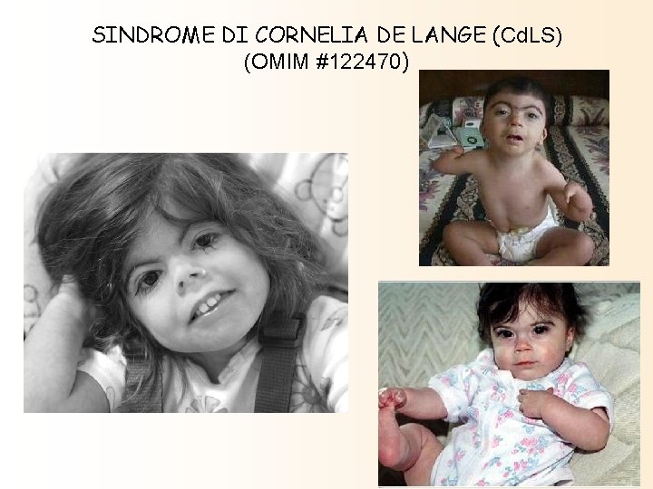 SINDROME DI CORNELIA DE LANGE (Cd. LS) (OMIM #122470) SINDROME DI CORNELIA DE LANGE (Cd. LS) (OMIM #122470)