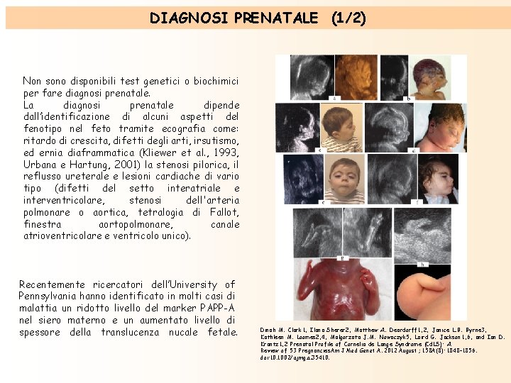 DIAGNOSI PRENATALE (1/2) Non sono disponibili test genetici o biochimici per fare diagnosi prenatale. DIAGNOSI PRENATALE (1/2) Non sono disponibili test genetici o biochimici per fare diagnosi prenatale.