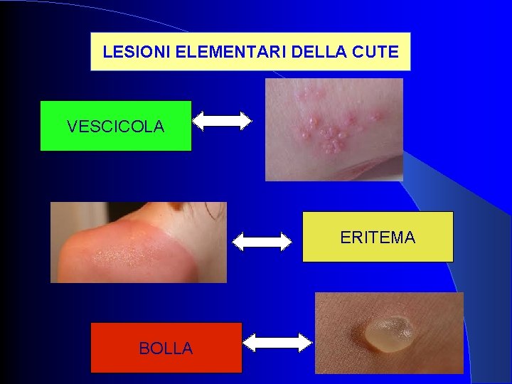 LESIONI ELEMENTARI DELLA CUTE VESCICOLA ERITEMA BOLLA 