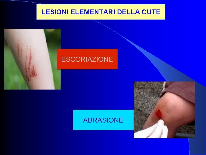 LESIONI ELEMENTARI DELLA CUTE ESCORIAZIONE ABRASIONE 