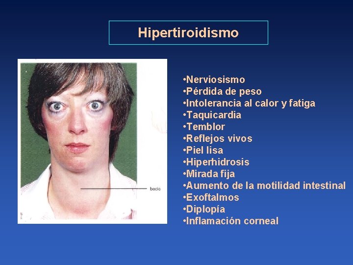 Hipertiroidismo • Nerviosismo • Pérdida de peso • Intolerancia al calor y fatiga •