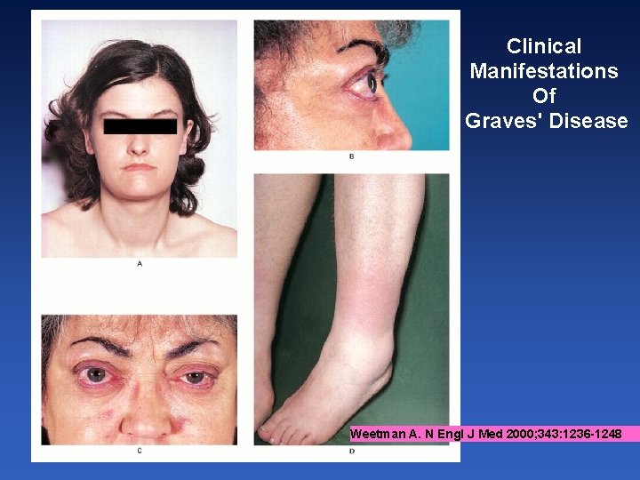 Clinical Manifestations Of Graves' Disease Weetman A. N Engl J Med 2000; 343: 1236