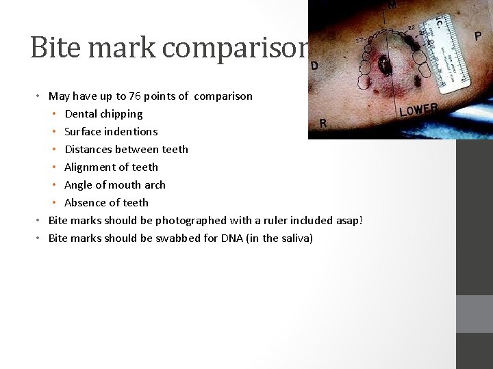 Bite mark comparisons • May have up to 76 points of comparison • Dental