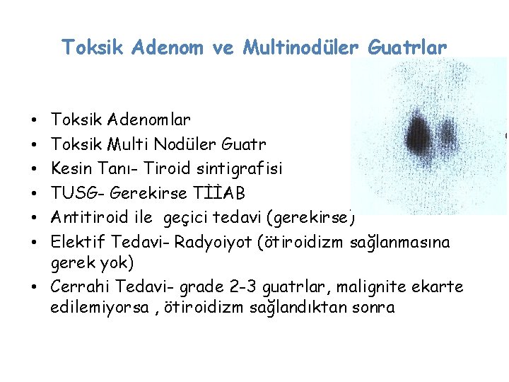 Toksik Adenom ve Multinodüler Guatrlar Toksik Adenomlar Toksik Multi Nodüler Guatr Kesin Tanı- Tiroid