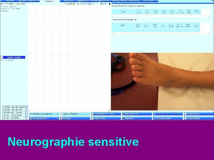 Neurographie sensitive 