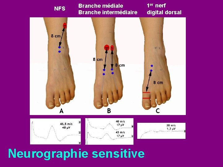 NFS Branche médiale Branche intermédiaire Neurographie sensitive 1 er nerf digital dorsal 