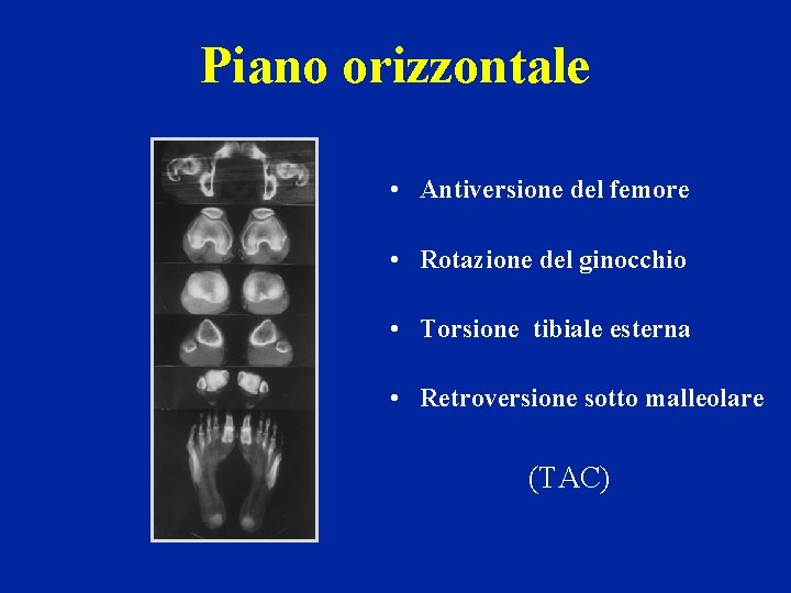 Piano orizzontale • Antiversione del femore • Rotazione del ginocchio • Torsione tibiale esterna