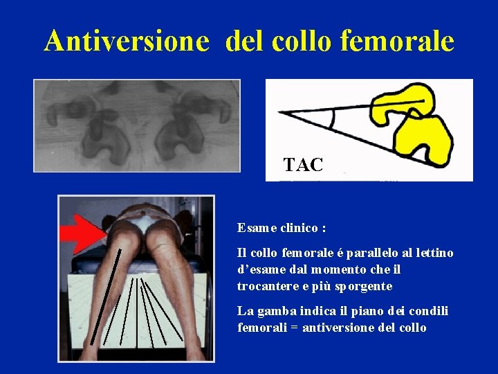 Antiversione del collo femorale TAC Esame clinico : Il collo femorale é parallelo al