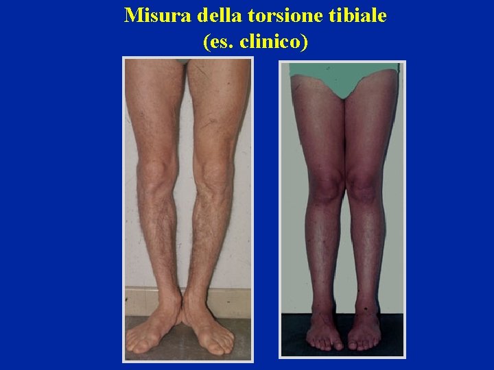 Misura della torsione tibiale (es. clinico) 