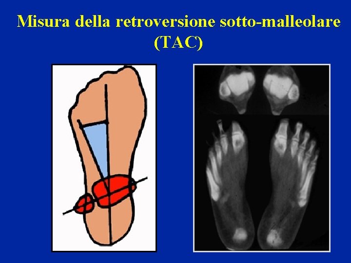 Misura della retroversione sotto-malleolare (TAC) 