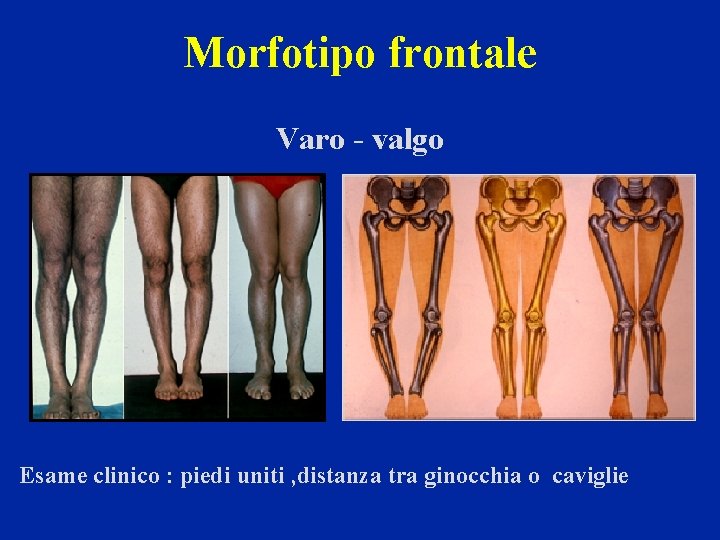 Morfotipo frontale Varo - valgo Esame clinico : piedi uniti , distanza tra ginocchia