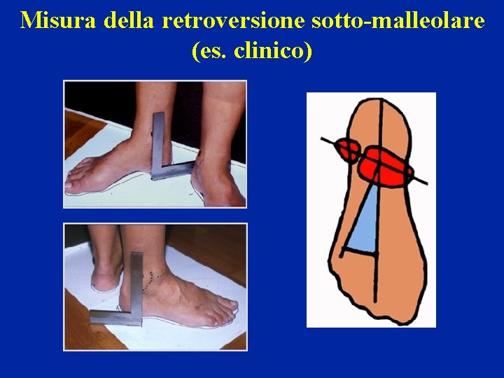 Misura della retroversione sotto-malleolare (es. clinico) 