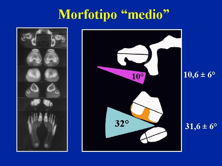 Morfotipo “medio” 10° 32° 10, 6 ± 6° 31, 6 ± 6° 