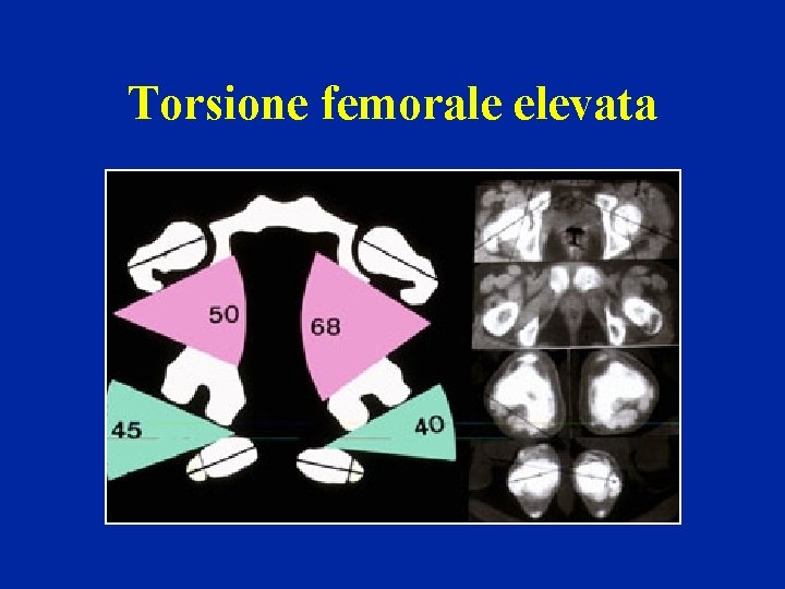 Torsione femorale elevata 