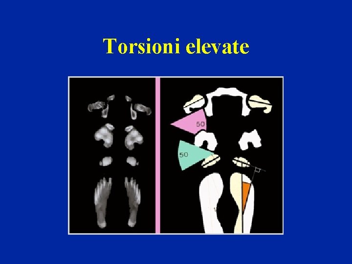 Torsioni elevate 