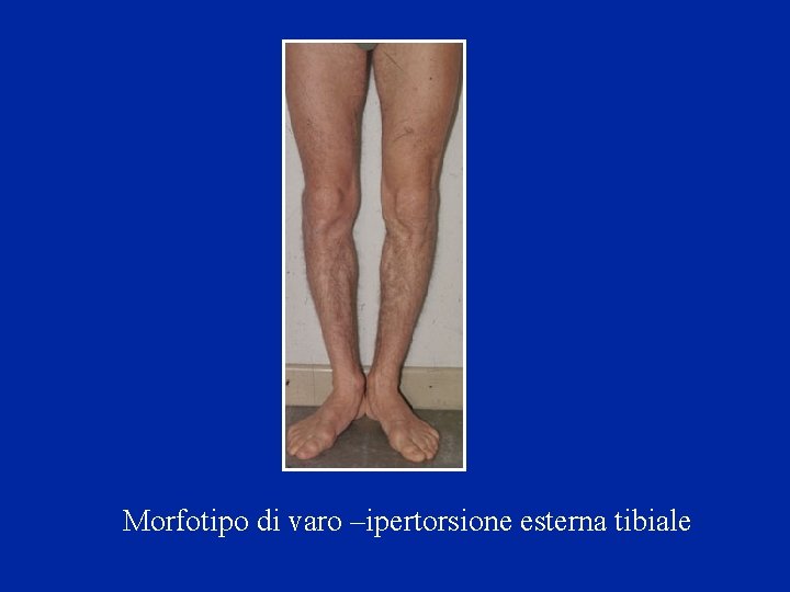 Morfotipo di varo –ipertorsione esterna tibiale 