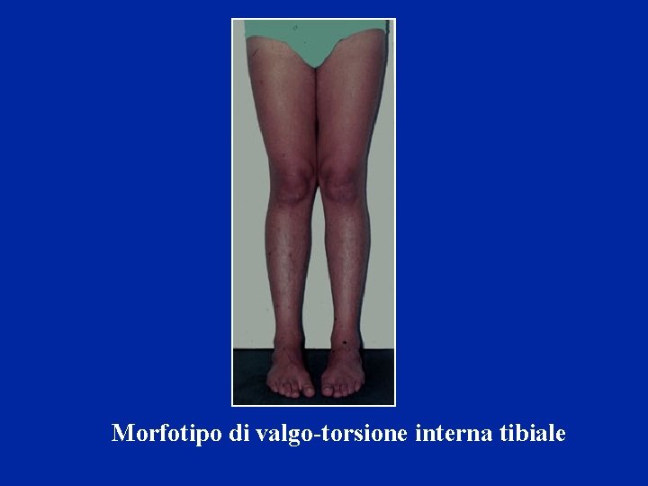 Morfotipo di valgo-torsione interna tibiale 