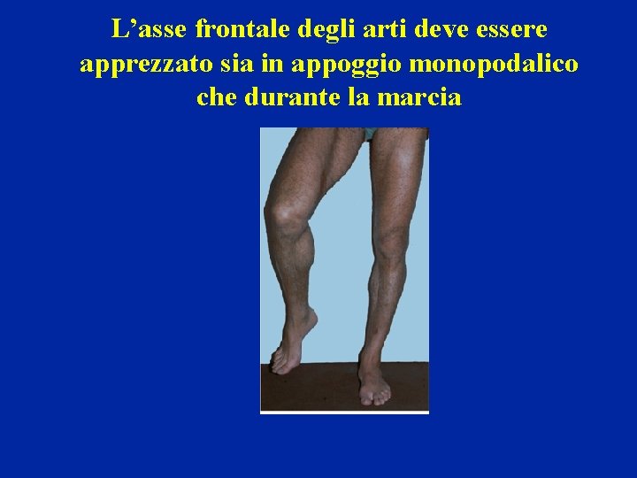 L’asse frontale degli arti deve essere apprezzato sia in appoggio monopodalico che durante la