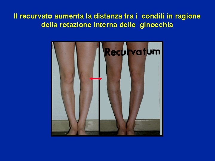 Il recurvato aumenta la distanza tra i condili in ragione della rotazione interna delle