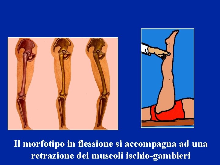 Il morfotipo in flessione si accompagna ad una retrazione dei muscoli ischio-gambieri 