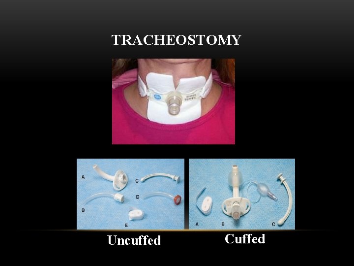 TRACHEOSTOMY Uncuffed Cuffed 