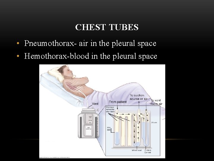 CHEST TUBES • Pneumothorax- air in the pleural space • Hemothorax-blood in the pleural