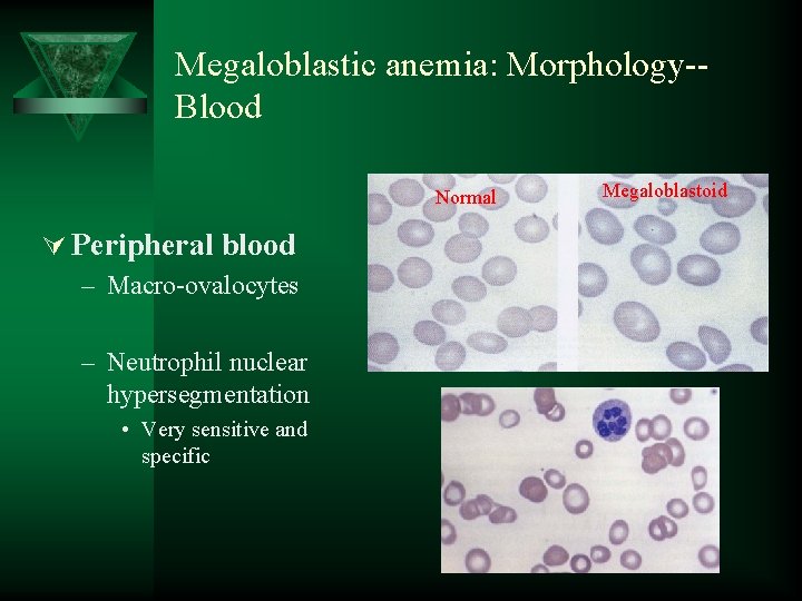 Megaloblastic anemia: Morphology-Blood Normal Ú Peripheral blood – Macro-ovalocytes – Neutrophil nuclear hypersegmentation •