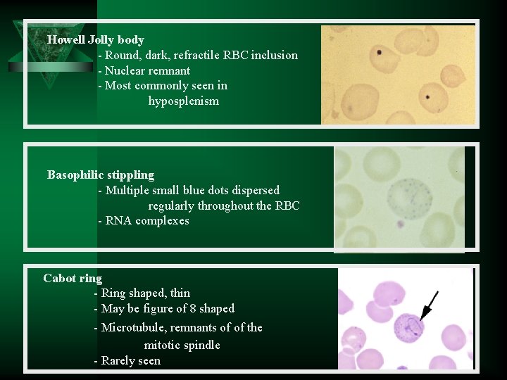 Howell Jolly body - Round, dark, refractile RBC inclusion - Nuclear remnant - Most