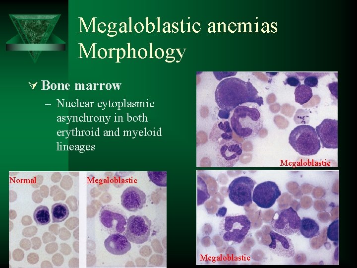 Megaloblastic anemias Morphology Ú Bone marrow – Nuclear cytoplasmic asynchrony in both erythroid and