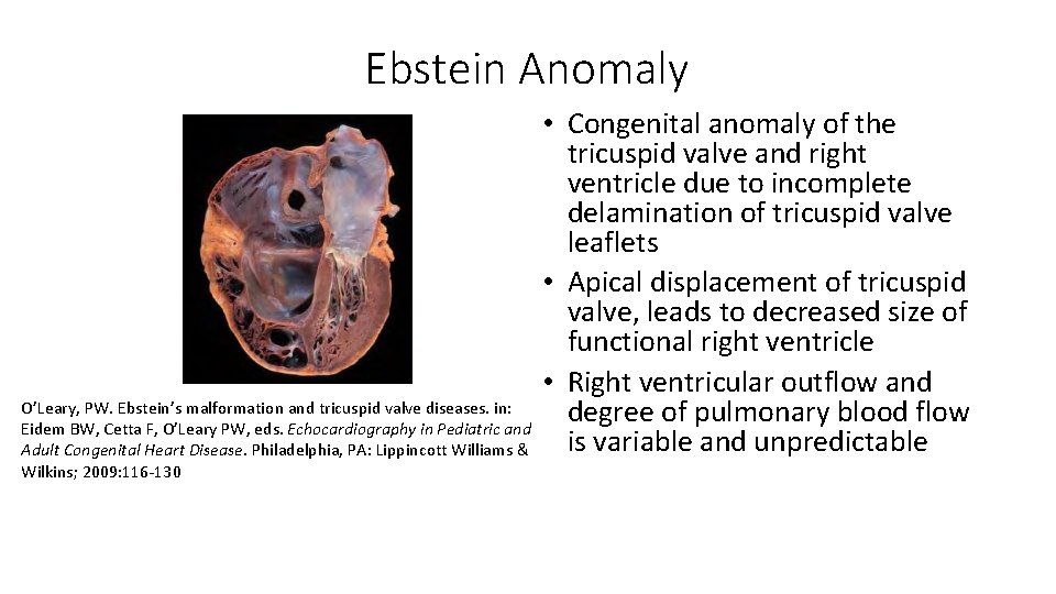 Ebstein Anomaly O’Leary, PW. Ebstein’s malformation and tricuspid valve diseases. in: Eidem BW, Cetta Ebstein Anomaly O’Leary, PW. Ebstein’s malformation and tricuspid valve diseases. in: Eidem BW, Cetta
