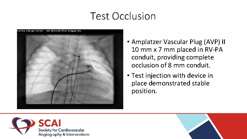 Test Occlusion • Amplatzer Vascular Plug (AVP) II 10 mm x 7 mm placed Test Occlusion • Amplatzer Vascular Plug (AVP) II 10 mm x 7 mm placed