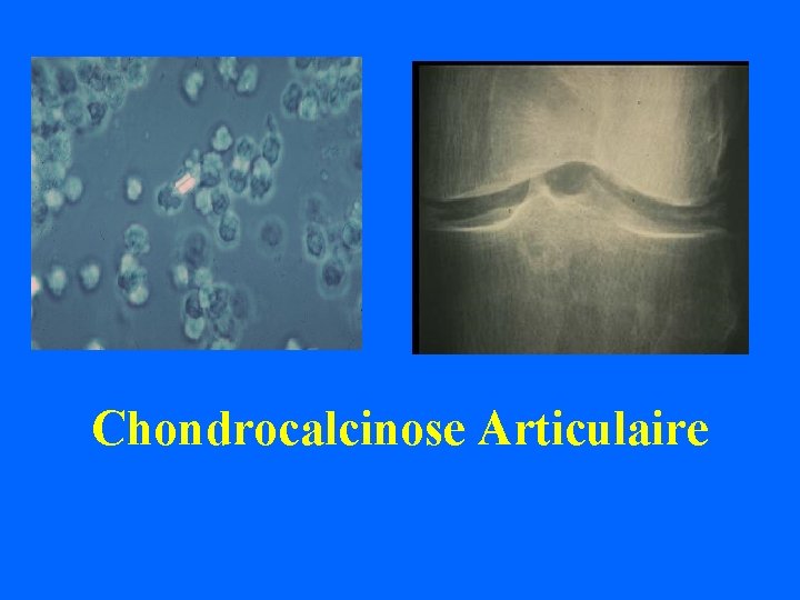 dddd Chondrocalcinose Articulaire 