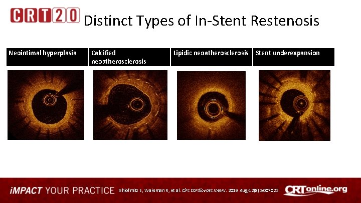 Distinct Types of In-Stent Restenosis Neointimal hyperplasia Calcified neoatherosclerosis Lipidic neoatherosclerosis Stent underexpansion Shlofmitz