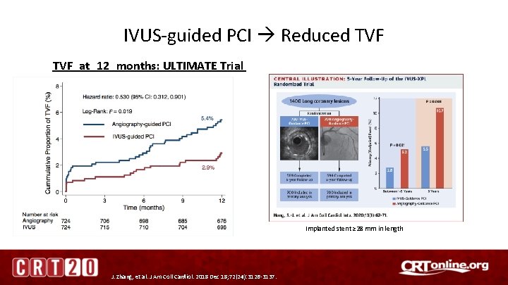 IVUS-guided PCI Reduced TVF at 12 months: ULTIMATE Trial Implanted stent ≥ 28 mm