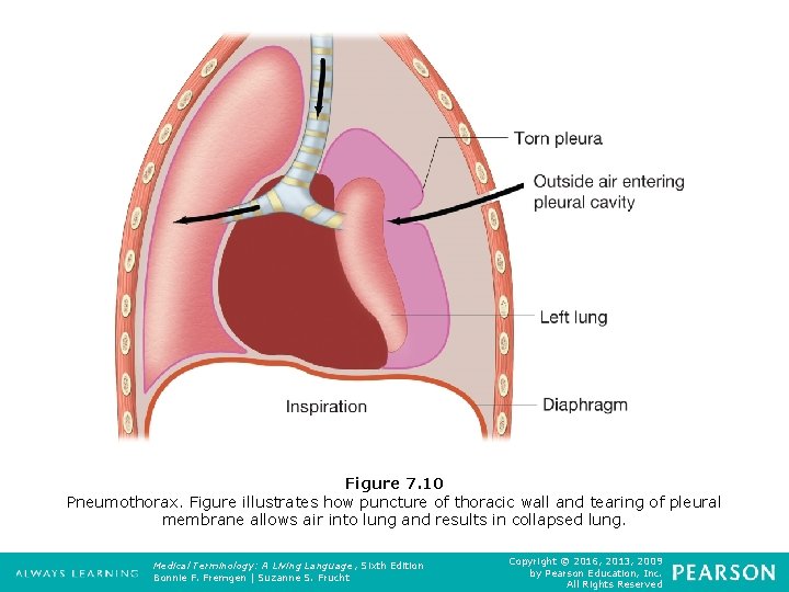 Figure 7. 10 Pneumothorax. Figure illustrates how puncture of thoracic wall and tearing of