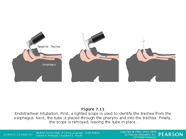 Figure 7. 11 Endotracheal intubation. First, a lighted scope is used to identify the