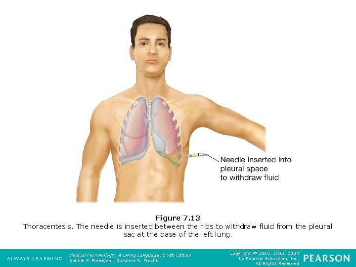 Figure 7. 13 Thoracentesis. The needle is inserted between the ribs to withdraw fluid