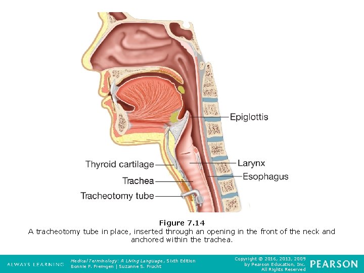 Figure 7. 14 A tracheotomy tube in place, inserted through an opening in the