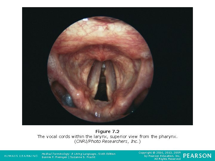 Figure 7. 2 The vocal cords within the larynx, superior view from the pharynx.