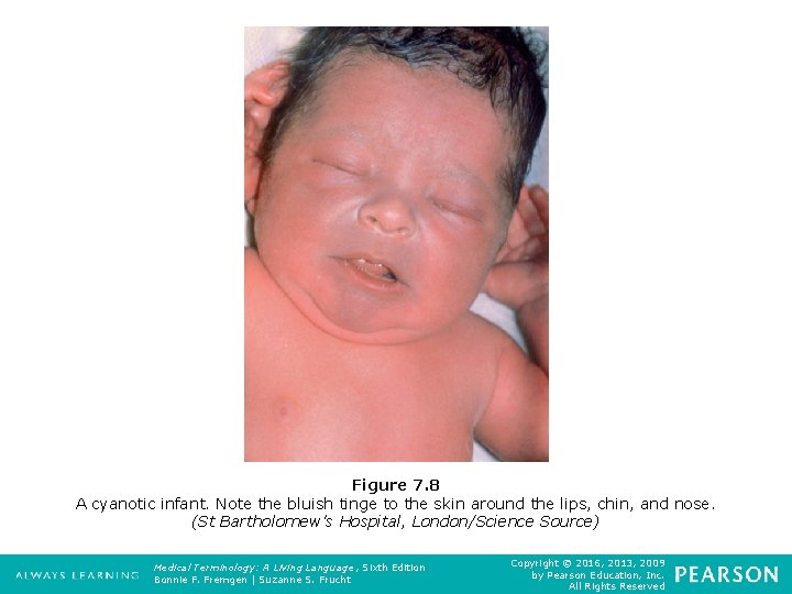 Figure 7. 8 A cyanotic infant. Note the bluish tinge to the skin around